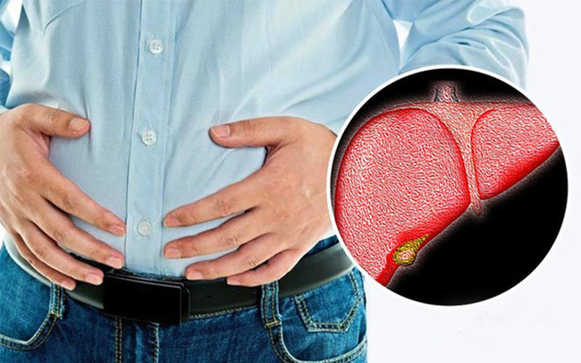 Giám đốc 40 tuổi không uống rượu, không hút thuốc nhưng vẫn mắc ung thư gan: Bác sĩ chỉ ra 4 thói quen tự đẩy mình vào